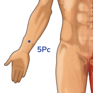 Jianshi - Point d'acupuncture 5Pc - Méridien du Péricarde